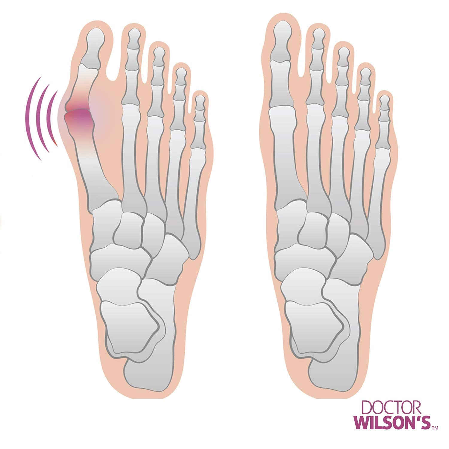 2 Bunion Relief Pads Sleeve - Bunion Splint Orthopedic Bunion Corrector Socks - Gel Pad Elastic Cushions Men and Women (1 Pair)